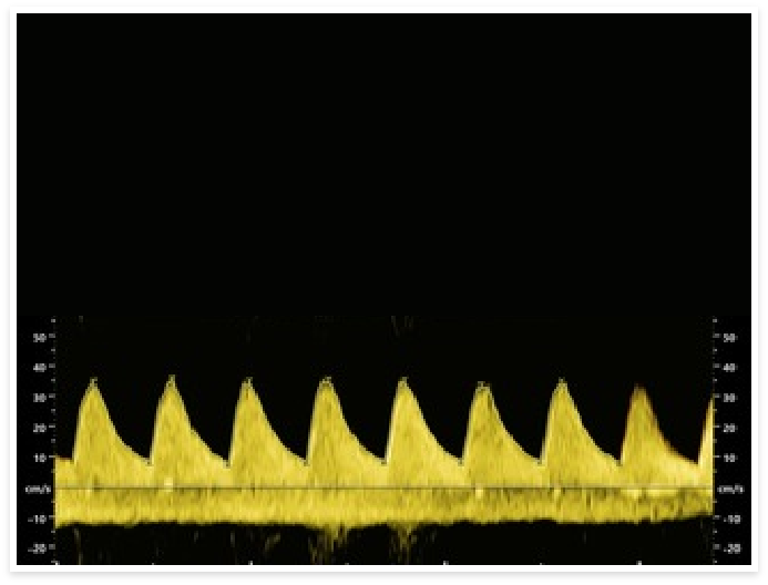 Dopplerultraschall in der Pränataldiagnostik