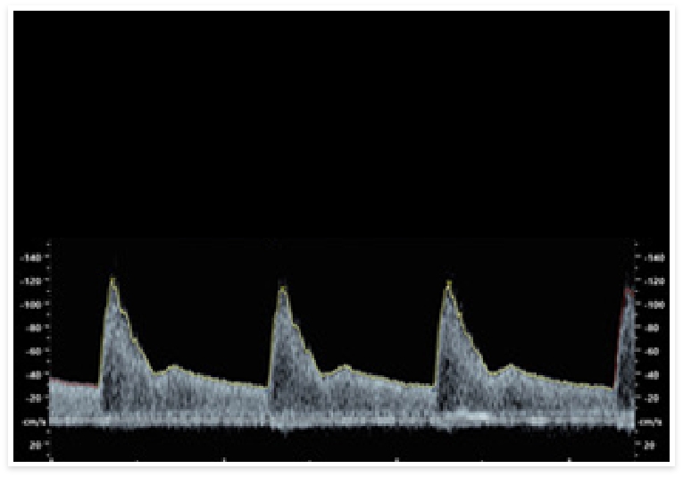 Präeklampsiescreening Ultraschall